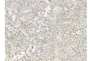 ABIN6256291 and ABIN6267489 at 1/100 staining human non-Hodgkin lymphoma by IHC-P.