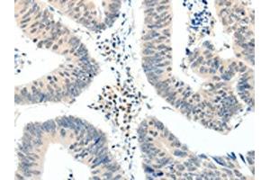 The image on the left is immunohistochemistry of paraffin-embedded Human colon cancer tissue using ABIN7192880(TRAF7 Antibody) at dilution 1/20, on the right is treated with synthetic peptide. (TRAF7 抗体)