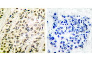 Peptide - +Immunohistochemical analysis of paraffin-embedded human breast carcinoma tissue using DP-1 antibody. (TGM4 抗体)