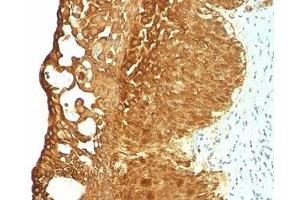 Formalin-fixed, paraffin-embedded human cervical carcinoma stained with Cytokeratin 19 antibody (KRT19/799) (Cytokeratin 19 抗体)
