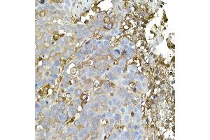 Immunohistochemistry of paraffin-embedded human esophageal cancer using C Rabbit mAb (ABIN7266058) at dilution of 1:50 (40x lens). (CAP1 抗体)