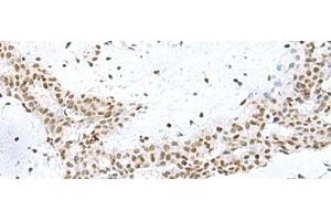Immunohistochemistry of paraffin-embedded Human breast cancer tissue using PUM3 Polyclonal Antibody at dilution of 1:80(x200) (Pumilio 3 抗体)