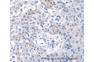 Immunohistochemistry of Human lung cancer using SLC10A1 Polyclonal Antibody at dilution of 1:31 (SLC10A1 抗体)
