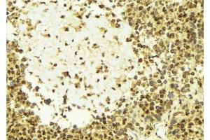 ABIN6277627 at 1/100 staining Human breast cancer tissue by IHC-P. (Plakophilin 2 抗体  (N-Term))