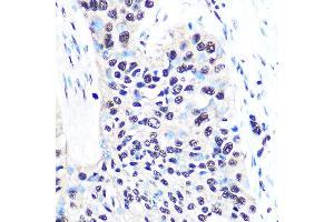 Immunohistochemistry of paraffin-embedded human esophageal cancer using NONO/p54nrb Rabbit mAb (ABIN7268947) at dilution of 1:100 (40x lens). (NONO 抗体)
