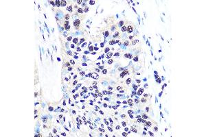 Immunohistochemistry of paraffin-embedded human esophageal cancer using NONO/p54nrb Rabbit mAb (ABIN7268947) at dilution of 1:100 (40x lens). (NONO 抗体)