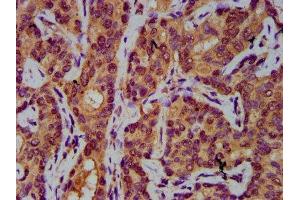IHC image of ABIN7143840 diluted at 1:400 and staining in paraffin-embedded human liver cancer performed on a Leica BondTM system. (AASS 抗体  (AA 224-364))