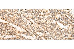 Immunohistochemistry of paraffin-embedded Human liver cancer tissue using GATD3B Polyclonal Antibody at dilution of 1:35(x200) (C21orf33 抗体)