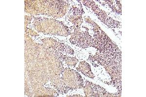 Immunohistochemical analysis of paraffin-embedded human lung adenocarcinoma tissue using ASK1 (Phospho-Ser83) Antibody (E012058). (ASK1 抗体  (pSer83))