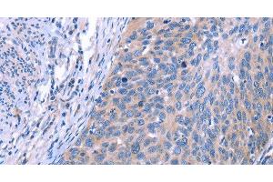 Immunohistochemistry of paraffin-embedded Human cervical cancer using ESPL1 Polyclonal Antibody at dilution of 1:40 (Separase 抗体)