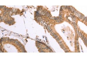 Immunohistochemistry of paraffin-embedded Human colon cancer using NAMPT Polyclonal Antibody at dilution of 1:30 (NAMPT 抗体)
