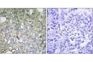 Immunohistochemistry analysis of paraffin-embedded human breast carcinoma tissue, using ADRA1D Antibody. (ADRA1D 抗体  (AA 451-500))