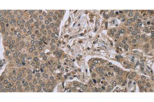 Immunohistochemistry of paraffin-embedded Human liver cancer tissue using IL15RA Polyclonal Antibody at dilution 1:45 (IL15RA 抗体)