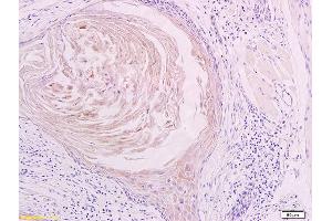 Formalin-fixed and paraffin embedded human oral squamous cell carcinoma labeled with Anti LYVE-1 Polyclonal Antibody, Unconjugated (ABIN674799) at 1:200 followed by conjugation to the secondary antibody and DAB staining (LYVE1 抗体  (AA 231-318))