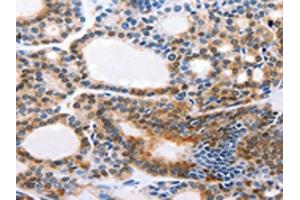 The image on the left is immunohistochemistry of paraffin-embedded Human thyroid cancer tissue using ABIN7190308(CMTM3 Antibody) at dilution 1/20, on the right is treated with synthetic peptide. (CMTM3 抗体)