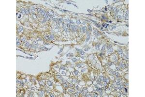 Immunohistochemistry of paraffin-embedded Human gastric cancer using CHMP4B Polyclonal Antibody at dilution of 1:100 (40x lens). (CHMP4B 抗体)