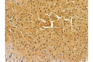 ABIN7095496 and ABIN7099553 at 1/100 staining human liver cancer by IHC-P.