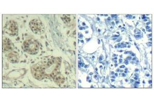 Immunohistochemical analysis of paraffin-embedded human breast carcinoma tissue using MDM2(Phospho-Ser166) Antibody(left) or the same antibody preincubated with blocking peptide(right). (MDM2 抗体  (pSer166))