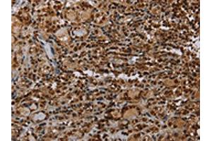 The image on the left is immunohistochemistry of paraffin-embedded Human thyroid cancer tissue using ABIN7192743(TBX5 Antibody) at dilution 1/35, on the right is treated with synthetic peptide. (T-Box 5 抗体)