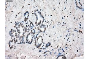 Immunohistochemical staining of paraffin-embedded Adenocarcinoma of colon tissue using anti-SLC7A8mouse monoclonal antibody. (SLC7A8 抗体)