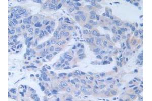 IHC-P analysis of Human Breast Cancer Tissue, with DAB staining. (ALT 抗体  (AA 255-496))