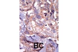 Formalin-fixed and paraffin-embedded human cancer tissue reacted with the primary antibody, which was peroxidase-conjugated to the secondary antibody, followed by AEC staining. (TXK 抗体  (N-Term))