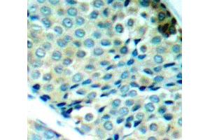 Immunohistochemistry of paraffin-embedded human breast carcinoma using Phospho-HSPB1-S78 antibody (ABIN2987689). (HSP27 抗体  (pSer78))