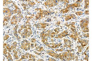 ABIN6260181 and ABIN6277800 at 1/100 staining Human liver cancer by IHC-P. (BACE1 抗体  (C-Term))