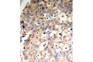 Immunohistochemistry of paraffin-embedded human breast carcinoma tissue, using Phospho-PTPN6-Y536 antibody (ABIN2988271). (SHP1 抗体  (pTyr536))