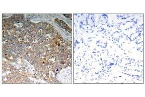 Immunohistochemical analysis of paraffin-embedded human breast carcinoma tissue using GSK3α/β(Phospho-Tyr279/216) Antibody (left) or the same antibody preincubated with blocking peptide (right). (Glycogen Synthase Kinase 3 (GSK3) (pTyr216), (pTyr279) 抗体)