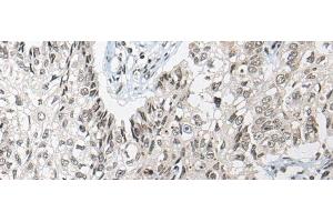 Immunohistochemistry of paraffin-embedded Human lung cancer tissue using DGKI Polyclonal Antibody at dilution of 1:80(x200) (DGKI 抗体)