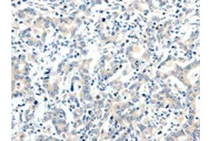 The image on the left is immunohistochemistry of paraffin-embedded Human gastric cancer tissue using ABIN7192880(TRAF7 Antibody) at dilution 1/20, on the right is treated with synthetic peptide. (TRAF7 抗体)