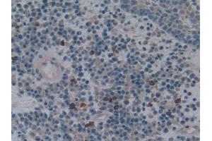 DAB staining on IHC-P; Samples: Human Skin cancer Tissue (HMOX1 抗体  (AA 61-172))