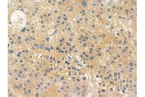 ABIN6256624 and ABIN6267265 at 1/100 staining human hepatocellular carcinoma by IHC-P. (EGFR 抗体  (pTyr1173, pTyr1197))
