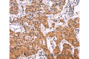 Immunohistochemistry of Human lung cancer using IL1RL1 Polyclonal Antibody at dilution of 1:70 (IL1RL1 抗体)