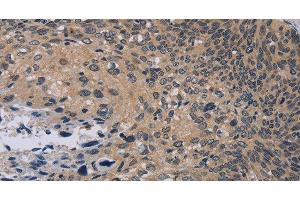 Immunohistochemistry of paraffin-embedded Human cervical cancer tissue using NOX1 Polyclonal Antibody at dilution 1:50 (NOX1 抗体)