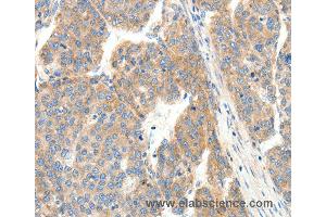 Immunohistochemistry of Human breast cancer using COL4A1 Polyclonal Antibody at dilution of 1:30 (COL4A1 抗体)