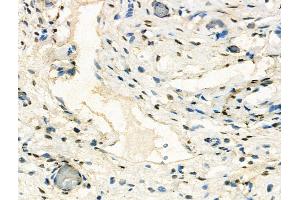 ABIN7094562 and ABIN7098611 at 1/100 staining Human ovarian cancer and adjacent normal tissues by IHC-P.