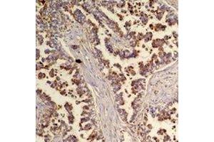Immunohistochemical analysis of Flotillin 2 staining in human lung cancer formalin fixed paraffin embedded tissue section. (Flotillin 2 抗体)