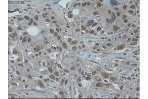 Immunohistochemical staining of paraffin-embedded Carcinoma of liver using anti-HNF6 (ABIN2452681) mouse monoclonal antibody. (ONECUT1 抗体  (AA 85-198))