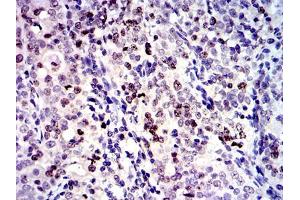 Immunohistochemical analysis of paraffin-embedded cervical cancer tissues using BIRC5 mouse mAb with DAB staining. (Survivin 抗体)