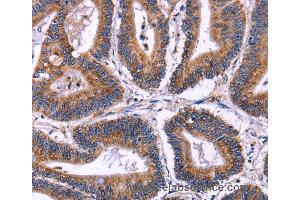 Immunohistochemistry of Human colon cancer using SIGLEC5 Polyclonal Antibody at dilution of 1:30 (SIGLEC5 抗体)