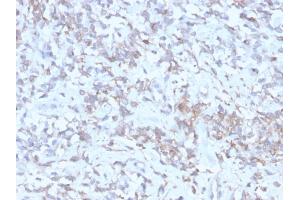 Formalin-fixed, paraffin-embedded human Hepatocellular Carcinoma stained with RBP1 Recombinant Mouse Monoclonal Antibody (rRBP1/872). (Recombinant RBP4 抗体)