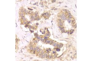 Immunohistochemistry of paraffin-embedded Human mammary cancer using CTNND1 antibody at dilution of 1:100 (x400 lens). (CTNND1 抗体)