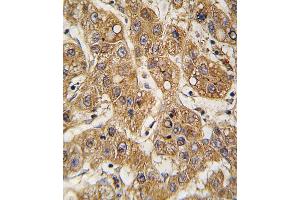 Formalin-fixed and paraffin-embedded human hepatocarcinoma tissue reacted with OE antibody (C-term) 7587b , which was peroxidase-conjugated to the secondary antibody, followed by DAB staining. (APOE 抗体  (C-Term))