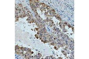 Immunohistochemical analysis of HSP70 staining in human lung cancer formalin fixed paraffin embedded tissue section. (HSP70 抗体)