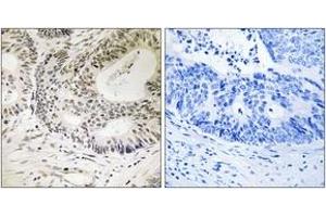 Immunohistochemistry analysis of paraffin-embedded human colon carcinoma, using 53BP1 (Phospho-Ser25) Antibody. (TP53BP1 抗体  (pSer25))