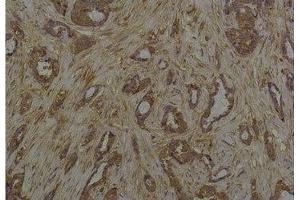 Immunohistochemical analysis of paraffin-embedded Human Breast Caricnoma using Phosphoserine Mouse mAb diluted at 1:200. (Phosphoserine 抗体)