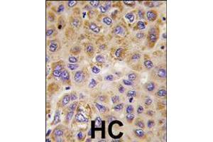 Formalin-fixed and paraffin-embedded human hepatocarcinoma tissue reacted with PFKFB1 antibody , which was peroxidase-conjugated to the secondary antibody, followed by DAB staining. (PFKFB1 抗体  (AA 259-289))
