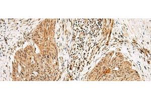 Immunohistochemistry of paraffin-embedded Human esophagus cancer tissue using GTF2H4 Polyclonal Antibody at dilution of 1:25(x200) (GTF2H4 抗体)
